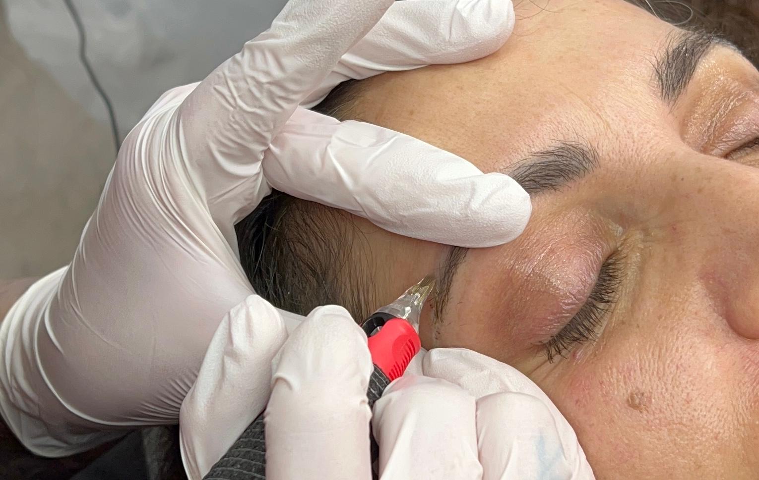 Non laser removal behandeling